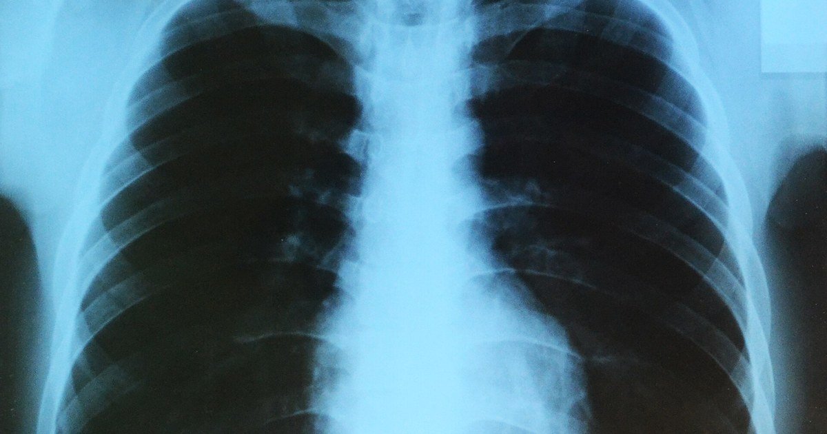 Cáncer de pulmón sin haber fumado nunca: por qué ocurre y qué señales no debes ignorar