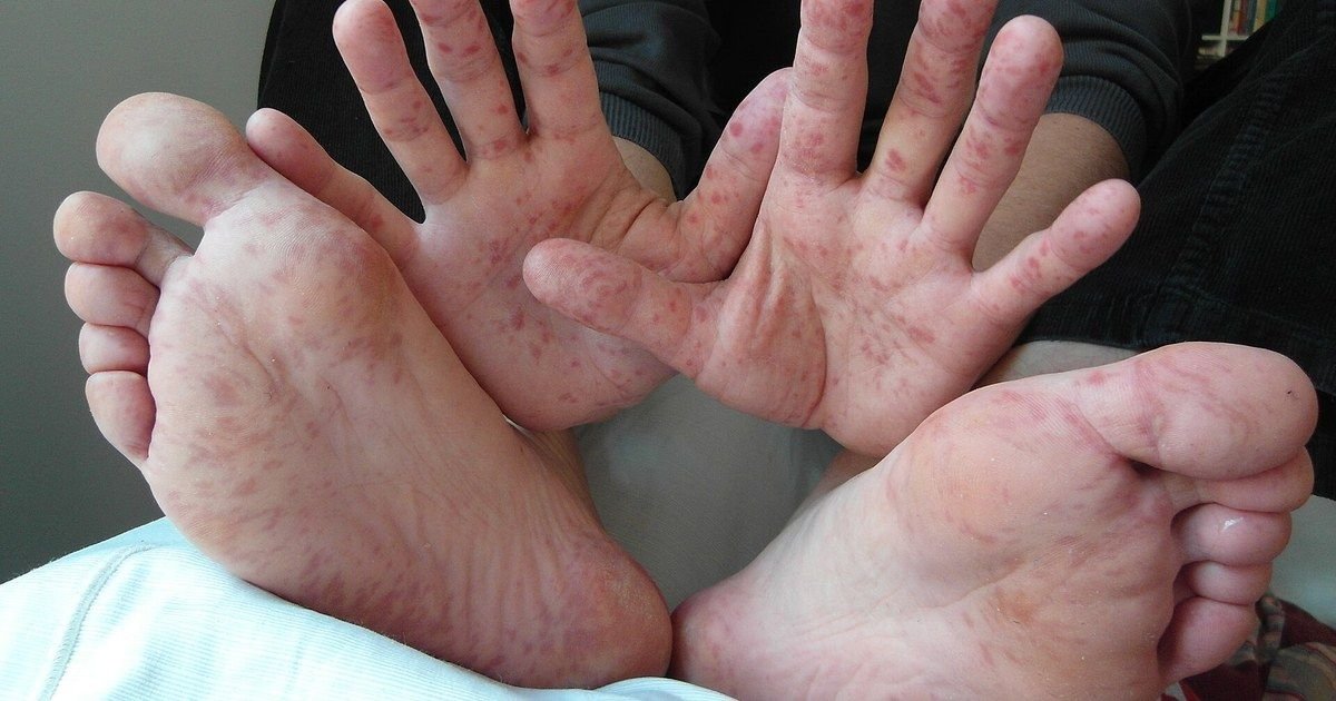 Virus Coxsackie: Zacatecas suma 209 casos y 30 brotes, la mayoría en guarderías; síntomas y cuidados